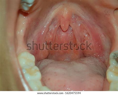 Pharyngitis Close Tonsillitis Inflammation Back Throat Stock Photo