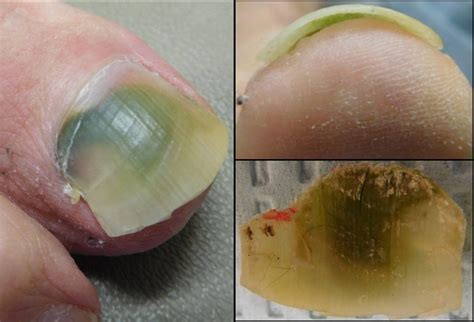 Fingernail And Toenail Abnormalities Nail The Diagnosis