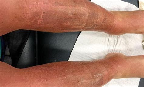 Woman Suffers Third Degree Burns From The Sun The Courier Mail