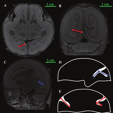 The Morphologic Evolution Of Fetal Lateral Ventricles At 14 31 Weeks