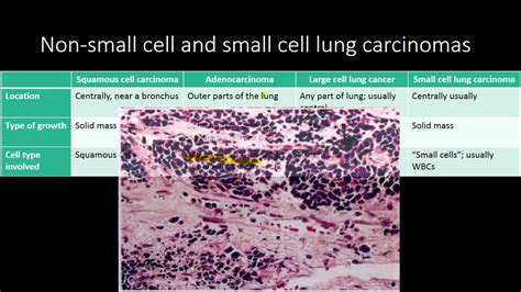 Small Cell Vs Non Small Cell Lung Carcinoma Youtube