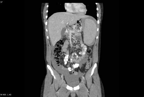 Medical School Splenic Rupture On Coronal View Of A Ct Scan