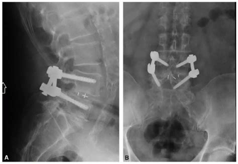 Minimally Invasive Transforaminal Lumbar Interbody Fusion