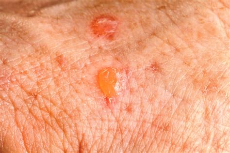 Actinic Keratosis In Brentwood Tn Brentwood Dermatology