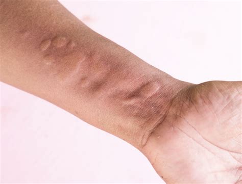 7 Causes Of Itchy Skin Pruritus Treatments For Rashes Bumps And More Dr Michelle Jeffries