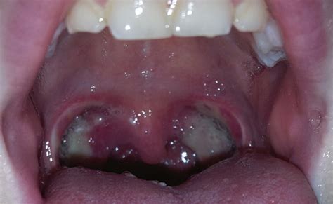 Can You Get White Spots On Tonsils From Vaping