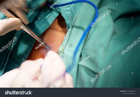 Excision Biopsy Procedure Elliptical Incision Using Stock Photo