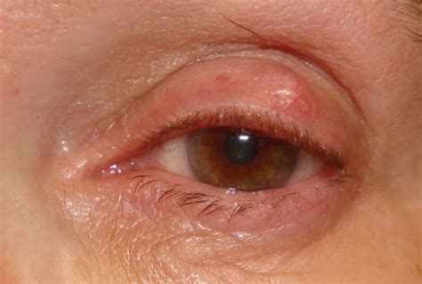 Bump On Eyelid Causes Symptoms Treatment Prevention Health Md