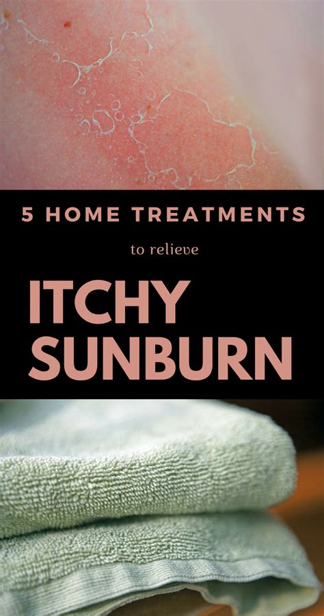 At Home Treatments Are The Most Effective For Sunburn Itch So Keep