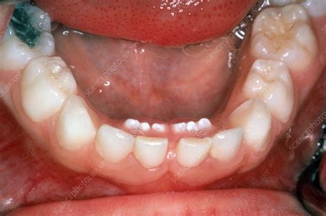 Permanent Teeth Eruption Stock Image C0392995 Science Photo Library