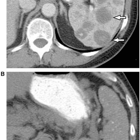 Peliosis Of Spleen Contrast Enhanced Ct Shows Multiple Hypodense