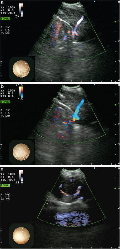 Endobronchial Ultrasound Guided Transbronchial Needle Aspiration