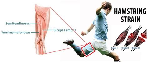 Hamstring Muscle Injury Cause Symptoms Diagnosis Exercise