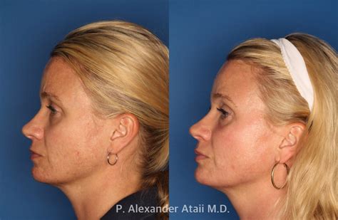 Patient 24560548 Ipl Photorejuvenation Before And After Photos Laser