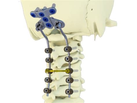 Platinum Occipito Cervico Thoracic Spinal Fixation System Enhanced