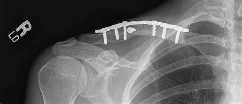 Broken Collarbone Or Clavicle Fracture Signs Symptoms And Treatment