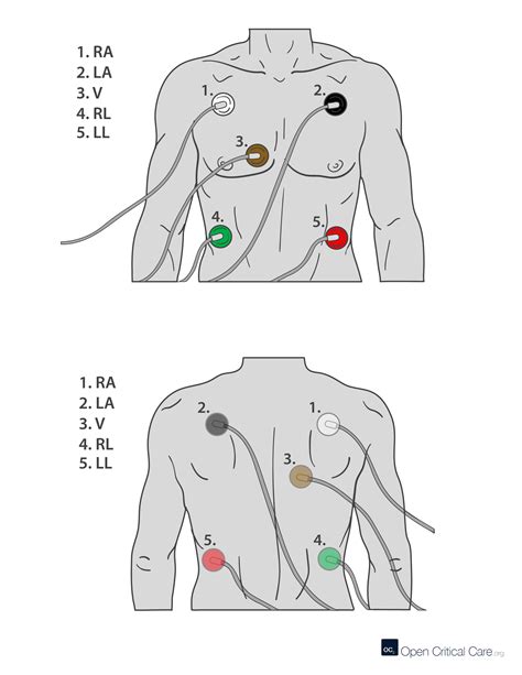 Ecg Electrode Placement Open Critical Care