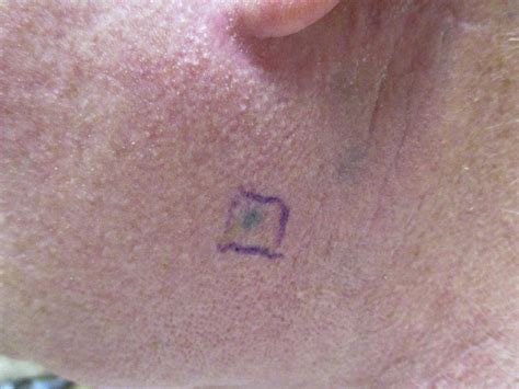 Metastatic Melanoma With Features Of Blue Nevus And Tumoral Melanosis