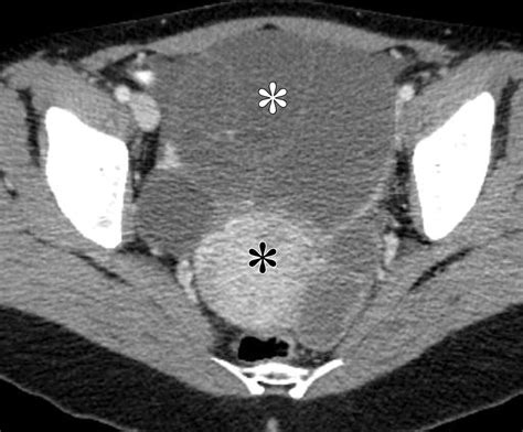 Mucinous Neoplasms Of The Ovary Radiologic Pathologic Correlation