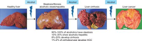 Figure 1 From Pathophysiology And Management Of Alcoholic Liver Disease