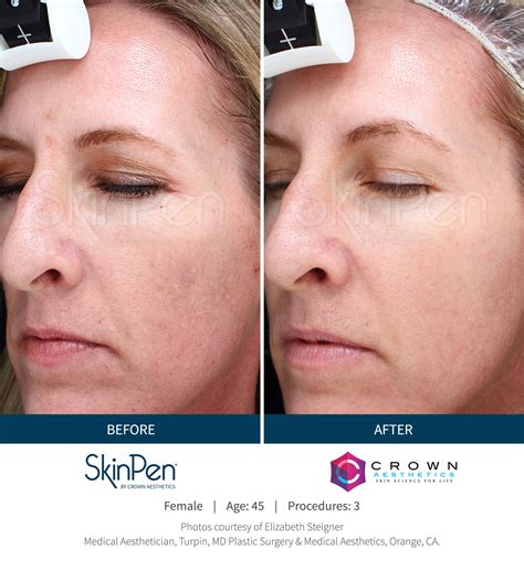 Skinpen Microneedling In Roswell Ga Skinpen Before And After
