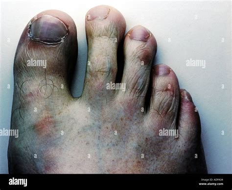 Bruised Toe Nails Hi Res Stock Photography And Images Alamy