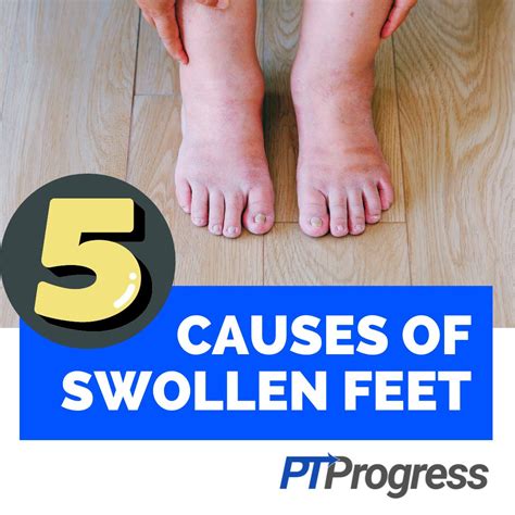 5 Reasons You Have Swollen Feet And Ankles