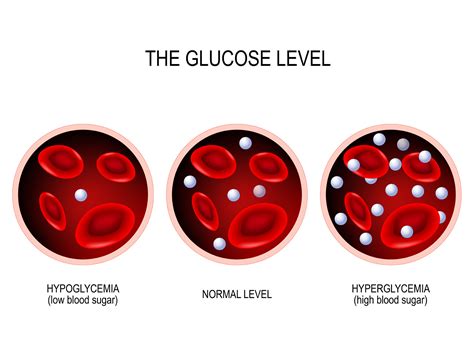 All About Hyperglycemia Apollo Sugar Clinics