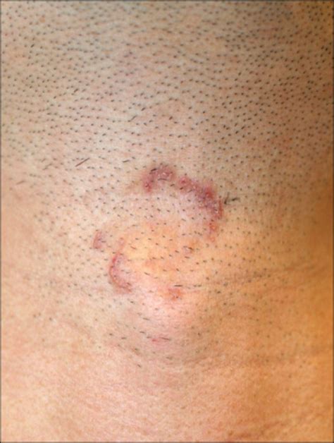Crusted Erythematous Papules 2~5 Mm In Size Arranged In An Annular