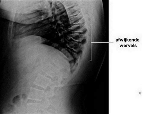 Scheuermann's disease, or scheuermann's kyphosis, is a condition in which the normal roundback in the upper spine is increased and results in a hunchback appearance, but rarely causes back pain. Ziekte van Scheuermann (juveniele osteochondrose van de ...