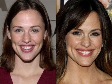 Pictures Celebrity Teeth Before And After Veneers Jennifer Garner