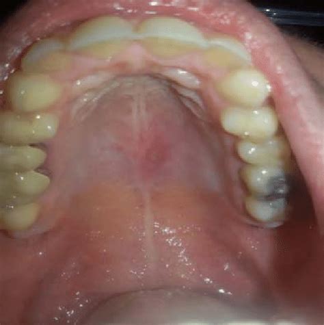 Single Ulcer Minor Than 10mm In The Hard Palate The Tissue
