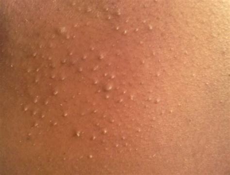 Causes And How To Get Rid Of Whiteheads On Arms