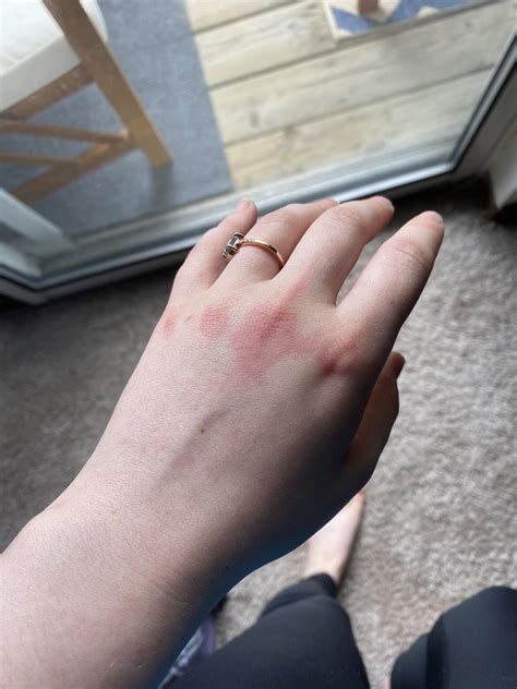 Does Anyone Else Get Weird Rashes On Their Knuckles Any Idea On Whats