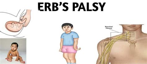 Erbs Palsy Mayfair Wellness Clinic