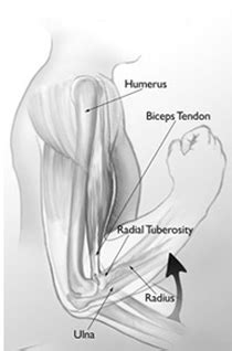 Unlike these others, the muscle belly is mostly in the upper part of the forearm and the tendon attaches to the wrist. DIstal Biceps Tendon Rupture - SHOULDER SURGERY + SPORTS ...