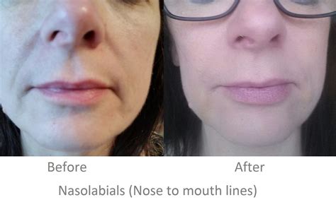 Correction Of Nasolabial Folds Using Dermal Filler Nasolabial Folds