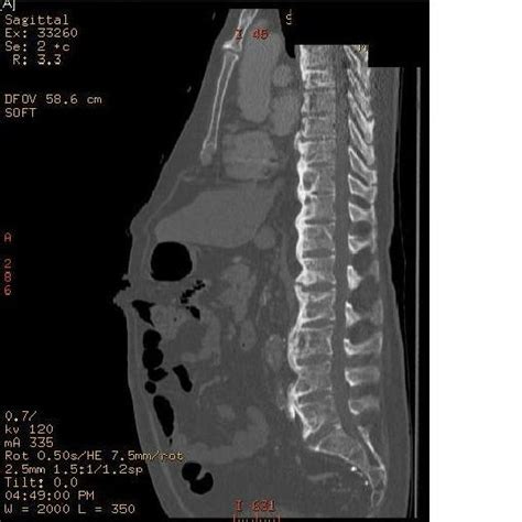 Contrast Enhanced Ct Of Abdomen Sagittal Reconstruction Shows