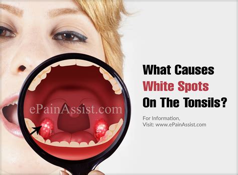 Sore Throat White Spots On Tonsils