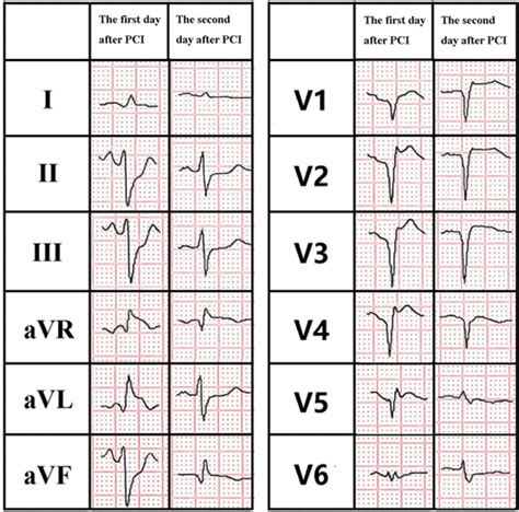 Anterior St Segment Elevation Myocardial Infarction Without St