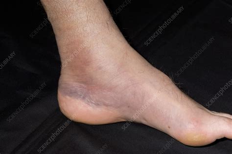 Bruised Ankle Stock Image M3301524 Science Photo Library