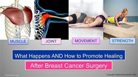 Promote Healing With Movement After Breast Cancer Surgery Youtube