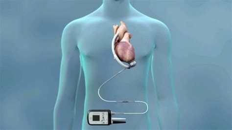 Ventricular Assist Devices Vads Division Of Cardiology
