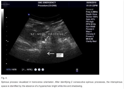 Emergency Medicine Educationultrasound For Lumbar Puncture