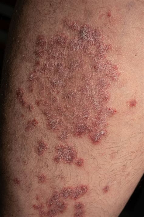 Guttate Psoriasis Symptoms Pictures And Treatment