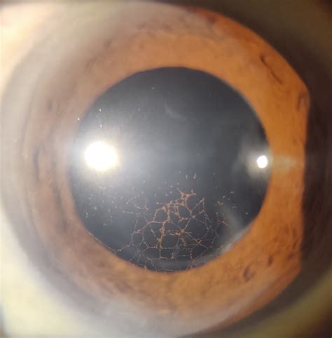 Reticular Keratic Precipitates Canadian Journal Of Ophthalmology