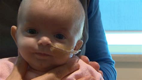Babies With Flat Heads Treated In Record Numbers Cbc News
