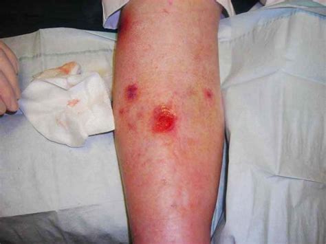 Skin Ulcer Causes Types Symptoms And Treatments