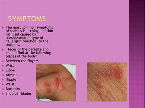 Ppt Scabies Mite Powerpoint Presentation Free Download Id2381798