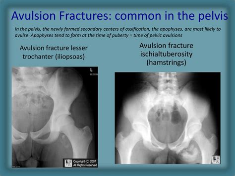 Pelvic Avulsion Fracture